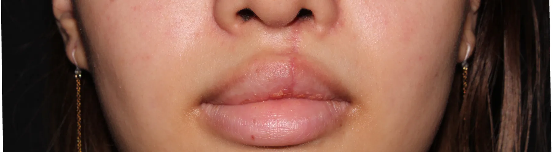 高濃度W-PRP療法 BEFORE画像