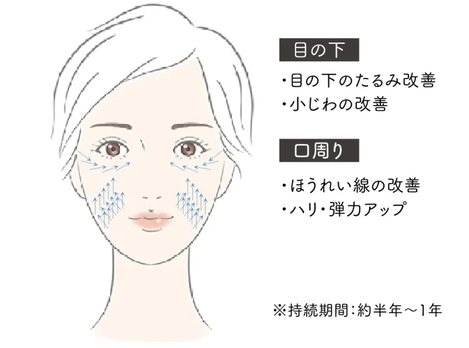 ショッピングリフトの適応部位