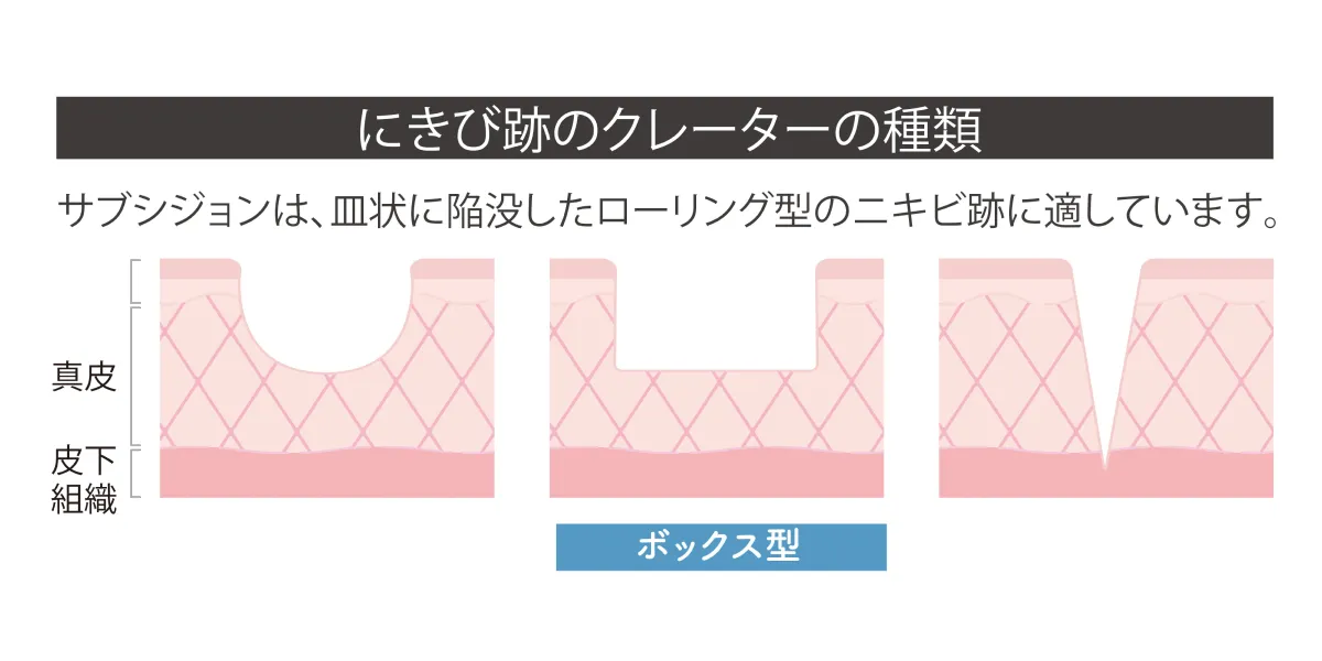 にきびのクレーターの種類