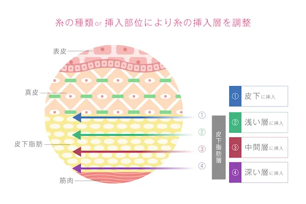 糸リフトの挿入目安の画像