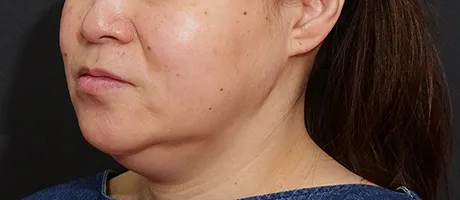 糸リフト AFTER画像