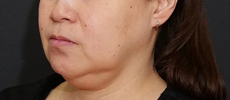 糸リフト BEFORE画像