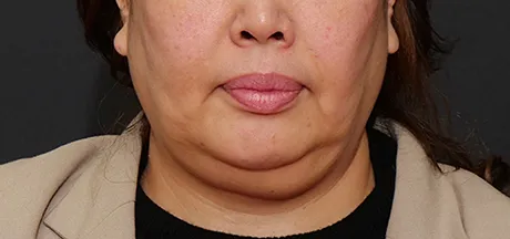 糸リフト BEFORE画像