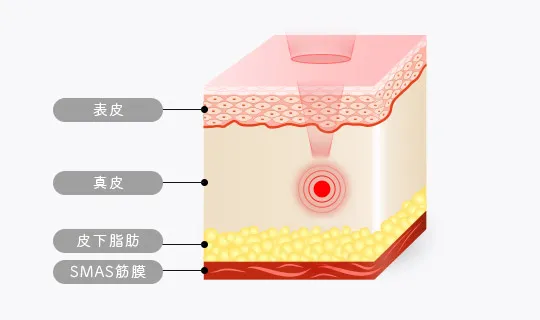 ウルトラセルQプラス1.5の施術効果イメージ