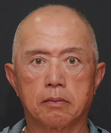 上まぶたのたるみ取り（眉毛下皮膚切除） AFTER画像