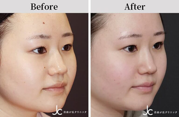 ホクロ除去の症例：施術前