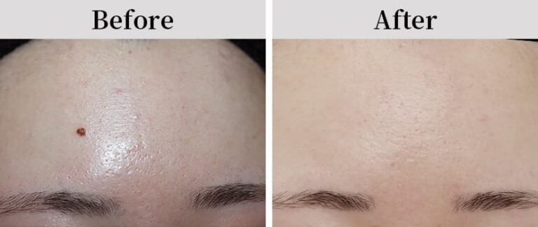 ホクロ除去の症例：施術後