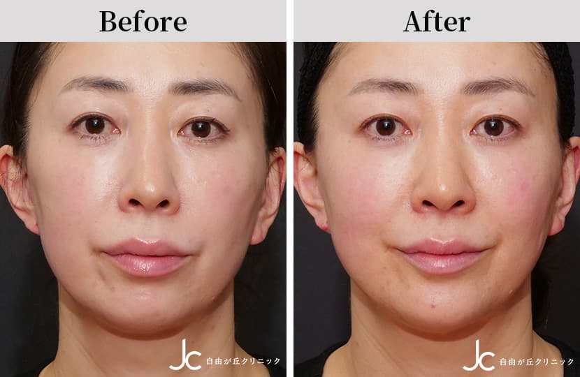 コンビネーション治療の症例：施術前