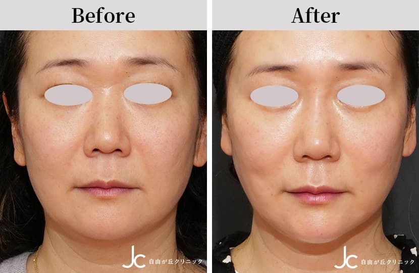 コンビネーション治療の症例：施術前