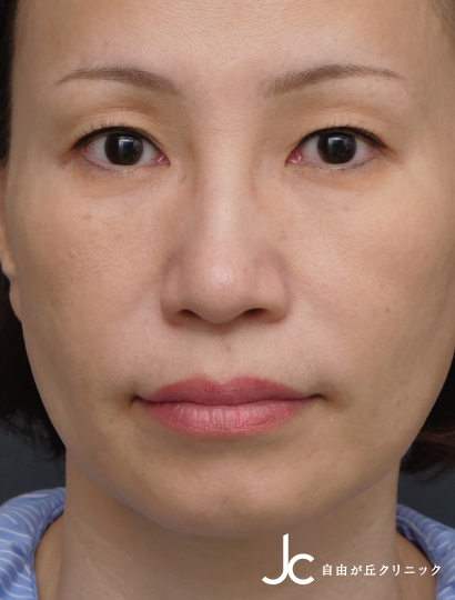 上まぶたのたるみ取り（眉毛下皮膚切除）<br>担当医：坂田芳洋BEFORE画像