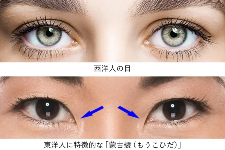 目頭切開「蒙古襞」
