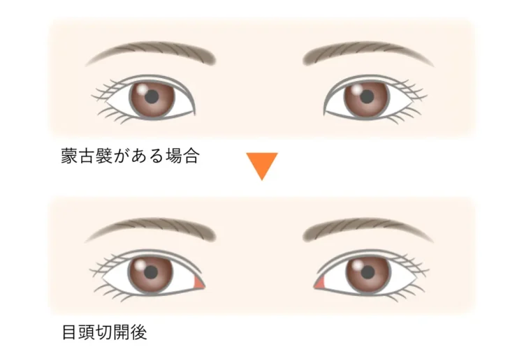 目頭切開
