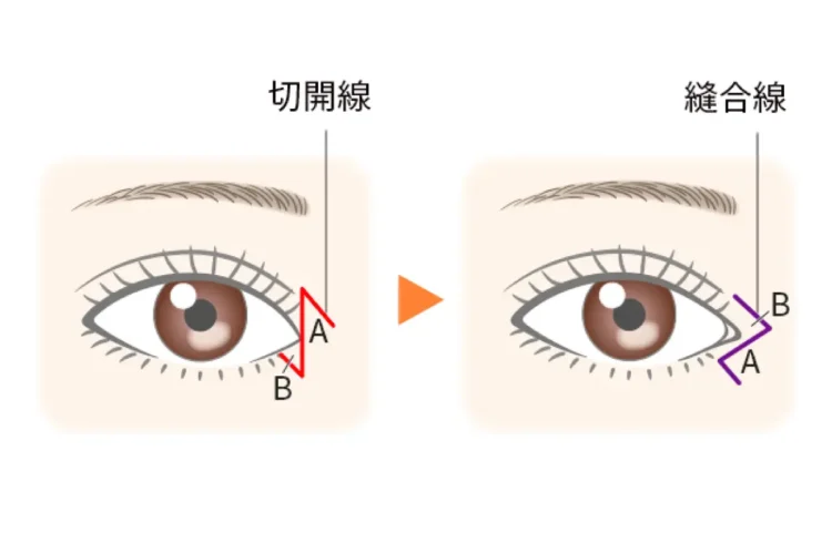 目頭切開　Z形式