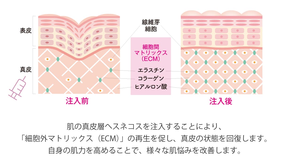 肌の真皮層へスネコスを注入することにより、「細胞外マトリックス（ECM）」の再生を促し、真皮の状態を回復します。自身の肌力を高めることで、様々な肌悩みを改善します。