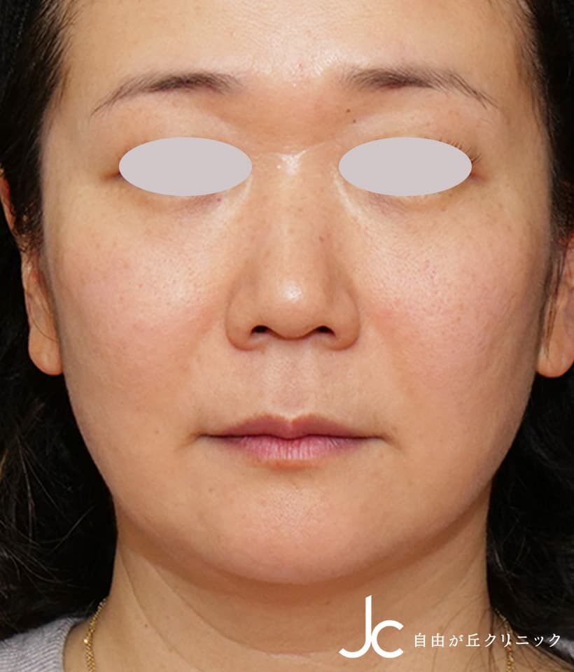 ヒアルロン酸注射BEFORE画像