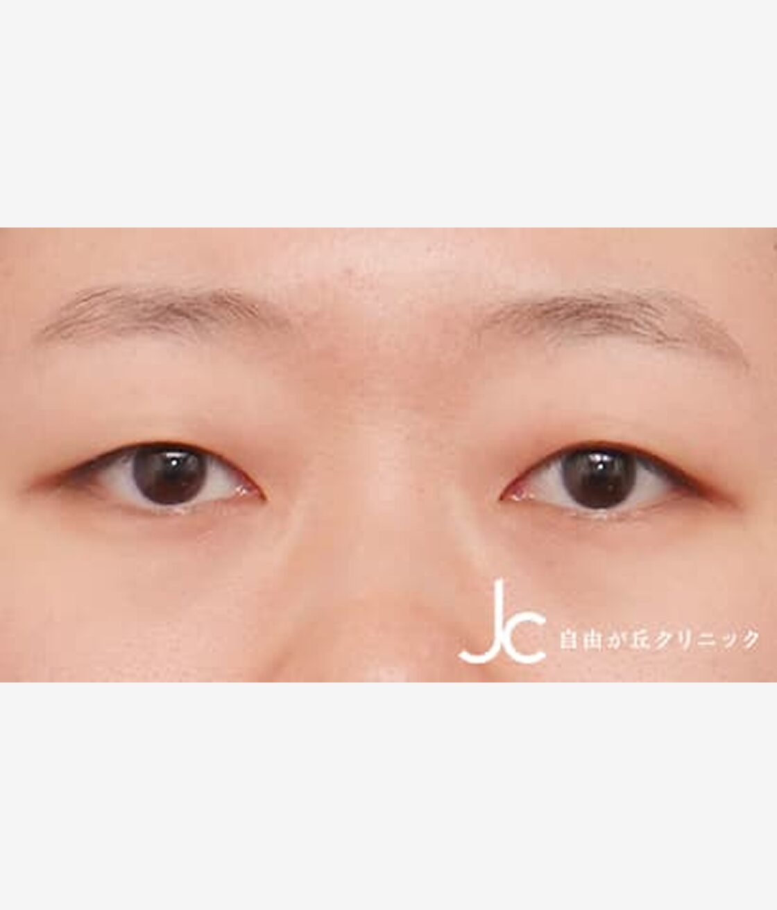 二重まぶた埋没法（3点法）BEFORE画像