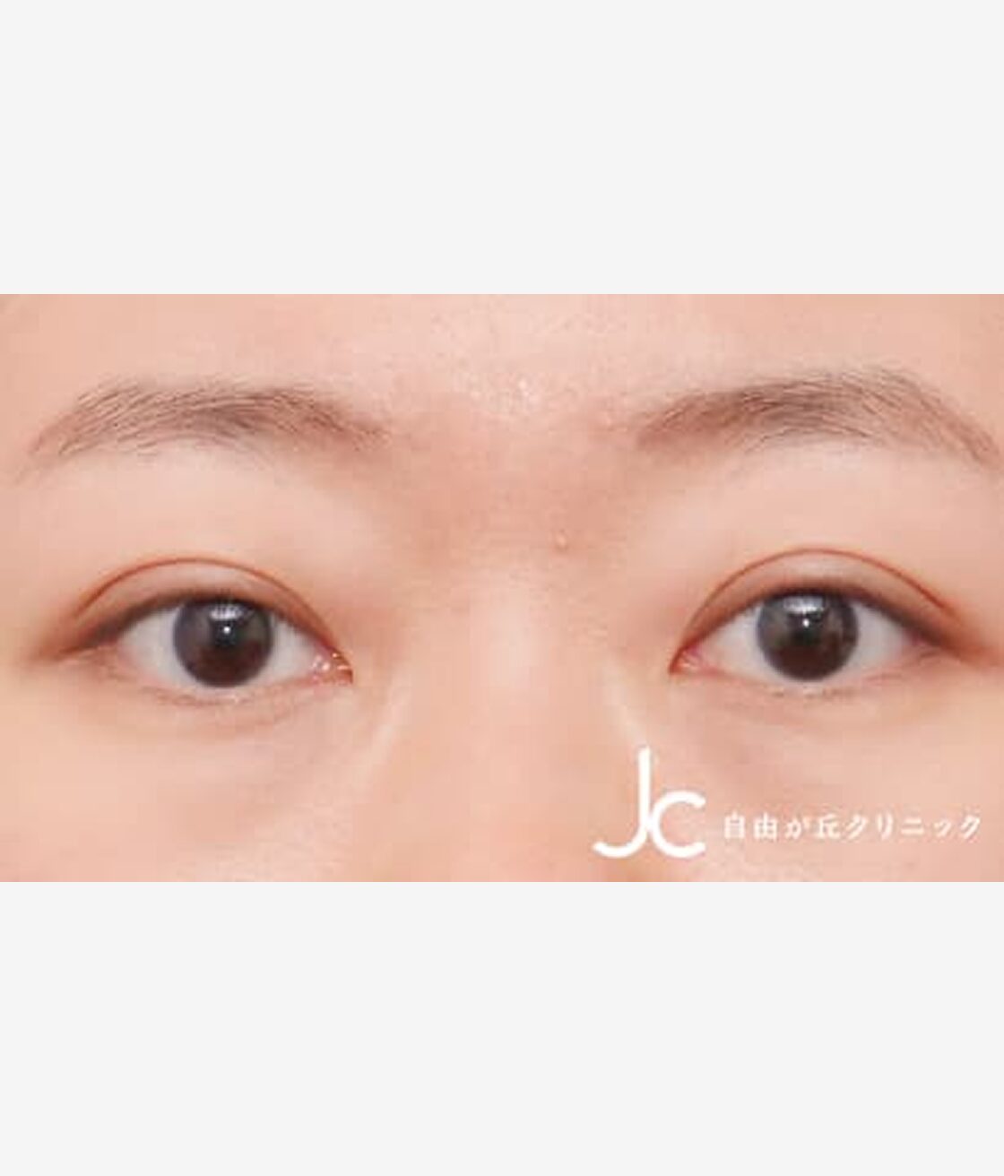 二重まぶた埋没法（3点法）AFTER画像