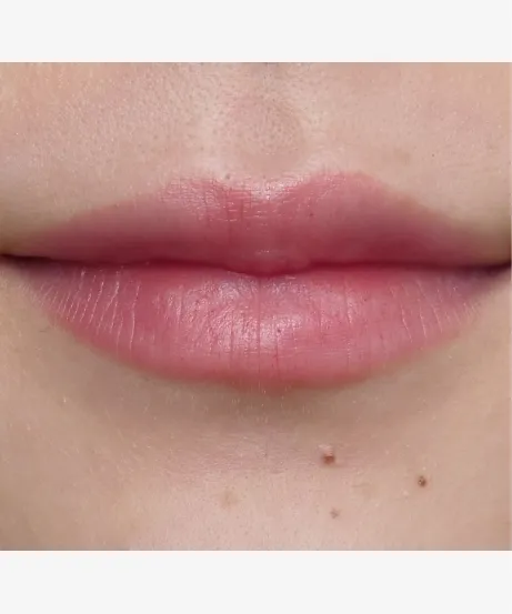 ヒアルロン酸注射 AFTER画像