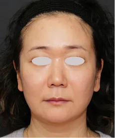 ヒアルロン酸注射<br>ボトックス注射<br>糸リフト BEFORE画像