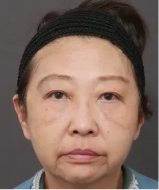 ヒアルロン酸注射<br>ボトックス注射<br>糸リフト AFTER画像