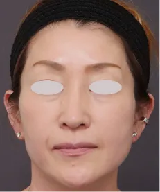 ヒアルロン酸注射<br>ボトックス注射 AFTER画像