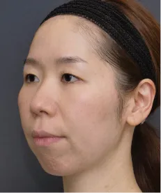 ヒアルロン酸注射<br>ボトックス注射 BEFORE画像