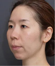 ヒアルロン酸注射<br>ボトックス注射 AFTER画像