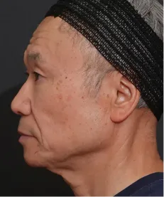 ヒアルロン酸注射<br>ボトックス注射<br>糸リフト BEFORE画像