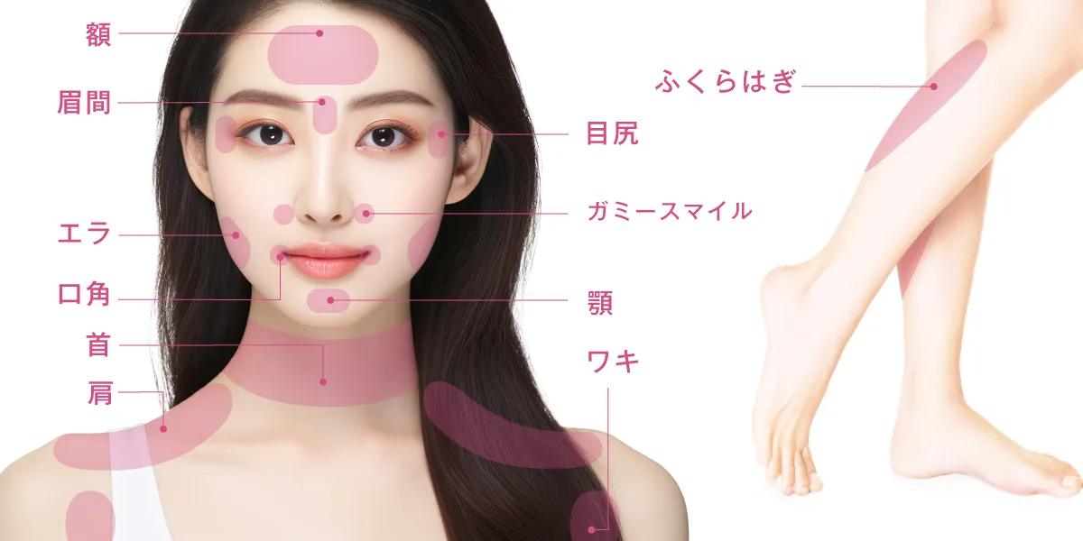 ボトックス注射(注入)の適応部位のイメージ画像