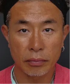 ヒアルロン酸注射<br>ボトックス注射<br>糸リフト AFTER画像