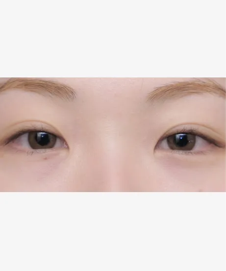 ヒアルロン酸注射 BEFORE画像