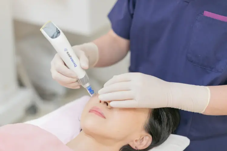 ダーマペンの治療風景