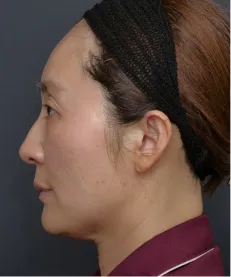 ヒアルロン酸注射<br>ボトックス注射<br>糸リフト AFTER画像