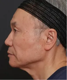 ヒアルロン酸注射<br>ボトックス注射<br>糸リフト AFTER画像