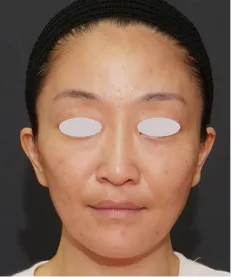 ヒアルロン酸注射<br>ボトックス注射 AFTER画像