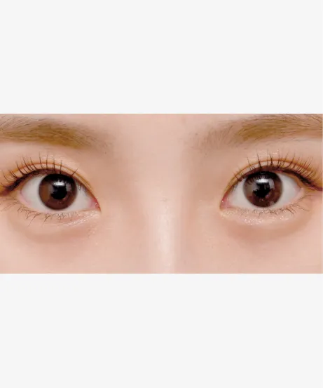 ヒアルロン酸注射 AFTER画像