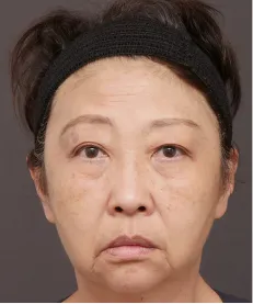 ヒアルロン酸注射<br>ボトックス注射<br>糸リフト BEFORE画像