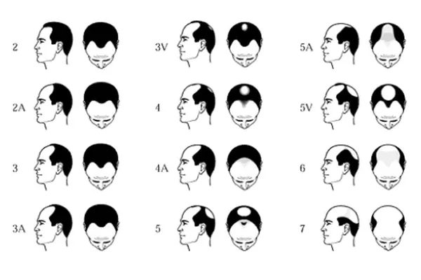 AGAの進行パターン