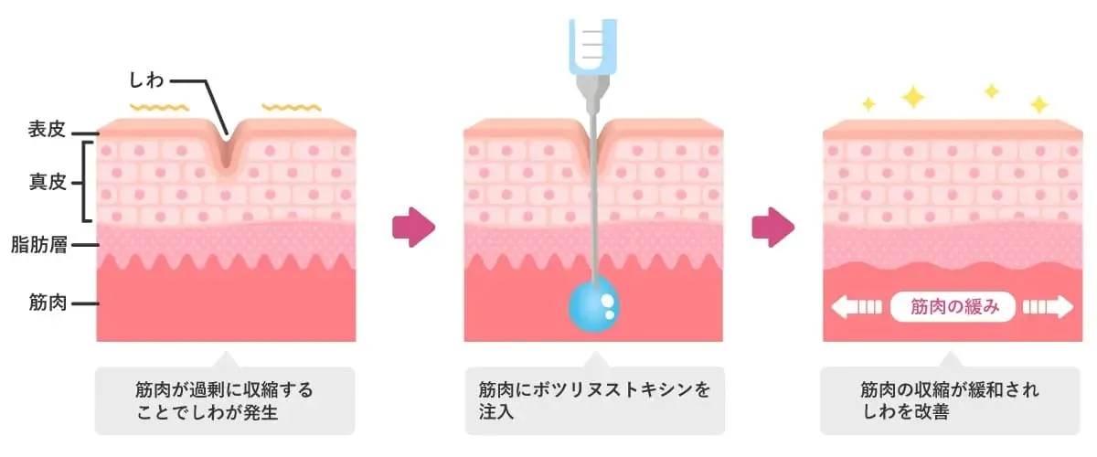 ボトックス注射の作用イメージ