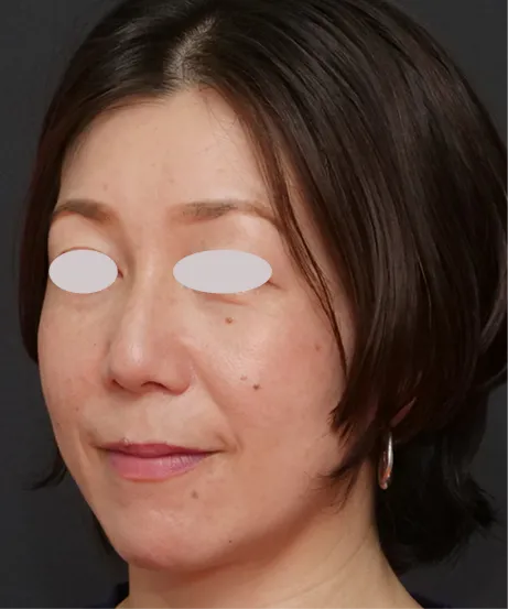 レーザー AFTER画像