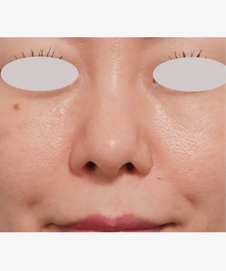 ダーマペン4（肌再生スタンダード） AFTER画像