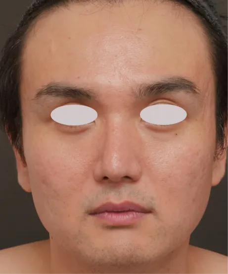 ダーマペン4（肌再生スタンダード） BEFORE画像