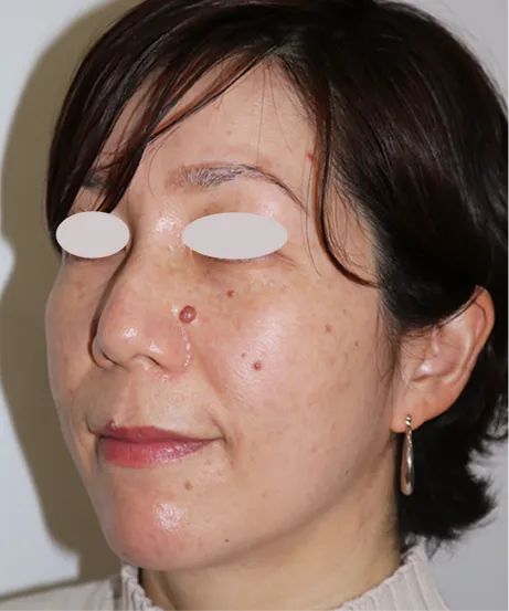 レーザー BEFORE画像