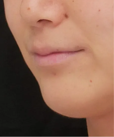 ヒアルロン酸注射 BEFORE画像