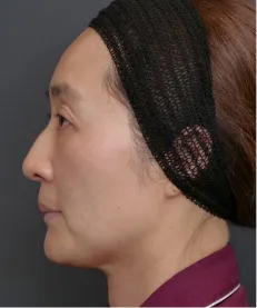 ヒアルロン酸注射<br>ボトックス注射<br>糸リフト BEFORE画像