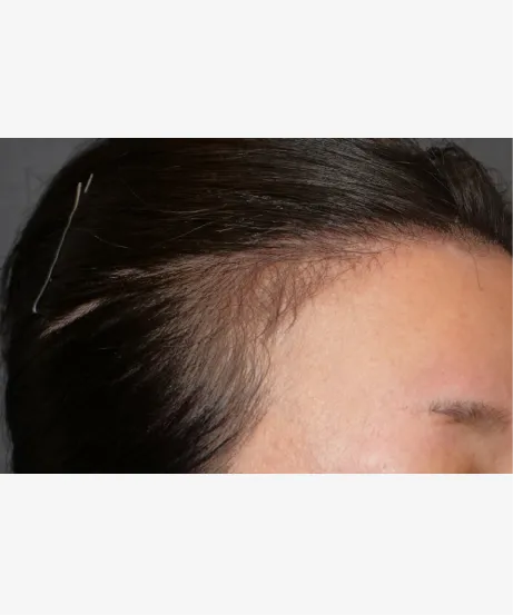 頭皮注射による薄毛治療（高濃度W-PRP療法） AFTER画像