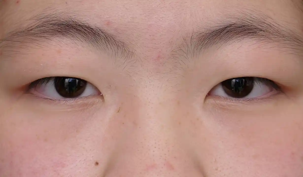 二重埋没（2点法）担当医：坂田芳洋 BEFORE画像