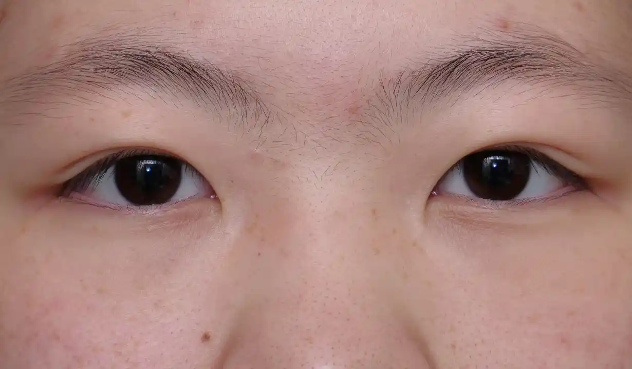 二重埋没（2点法）担当医：坂田芳洋 AFTER画像