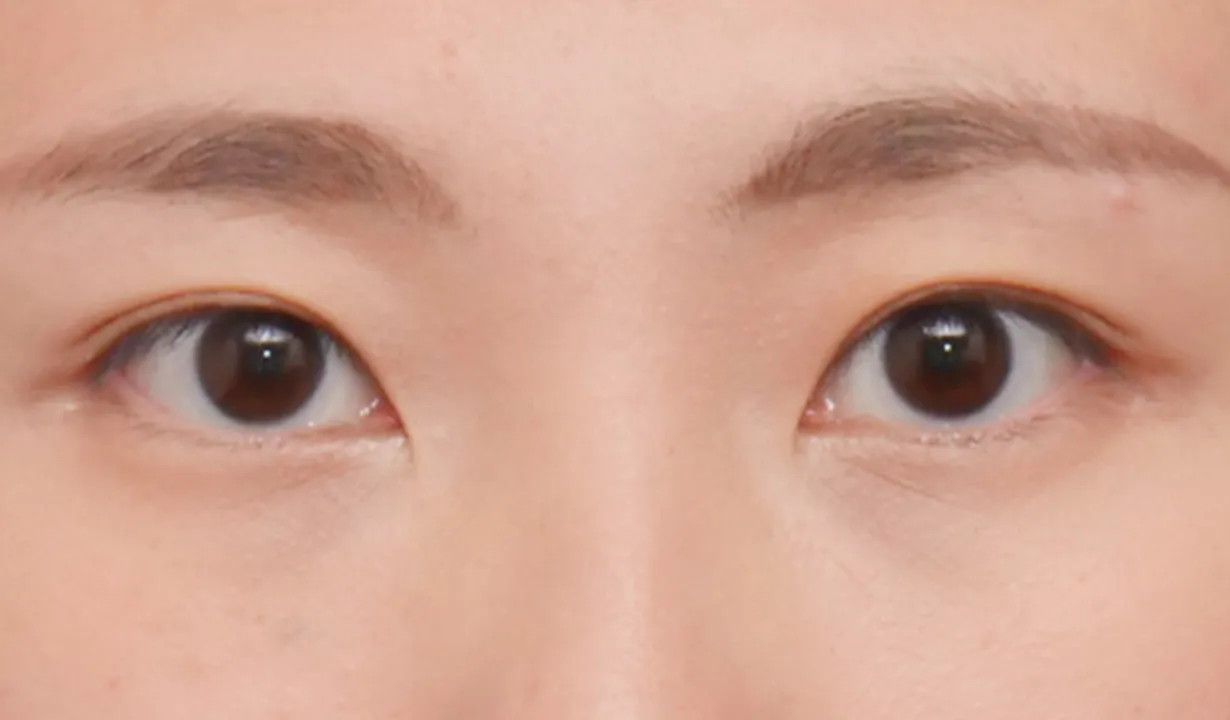 二重埋没（3点法） AFTER画像