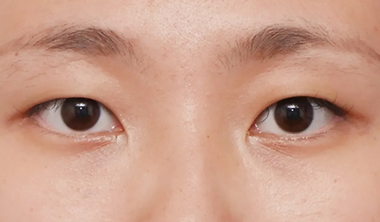 二重埋没（3点法） BEFORE画像